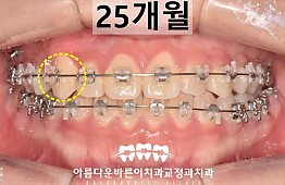 수술후