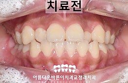 수술전