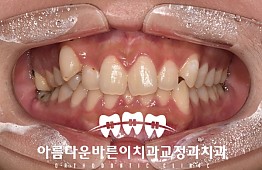 수술전