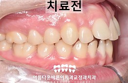 수술전