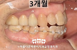 수술후