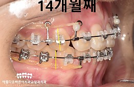 수술후