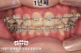 수술후