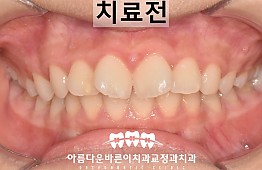 수술전