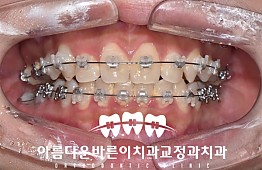 수술후