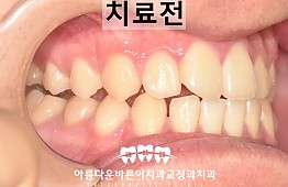 수술전