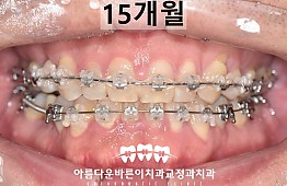 수술후