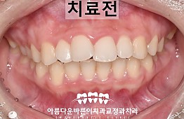 수술전