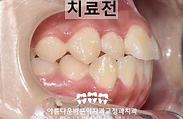 수술전