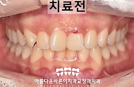 수술전