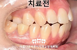 수술전