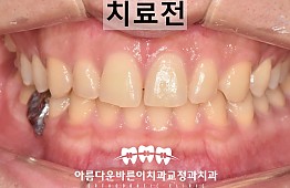 수술전