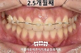 수술후