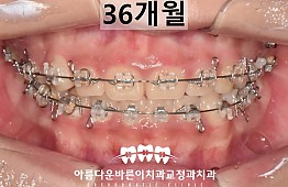 수술후