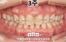 수술후