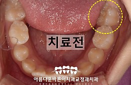 수술전