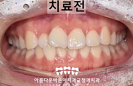 수술전