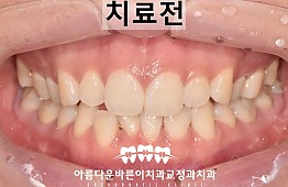 수술전