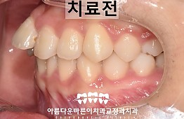 수술전