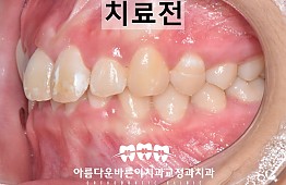 수술전