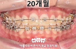 수술후