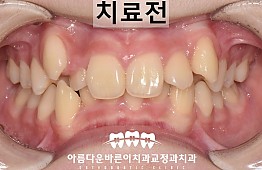 수술전