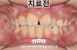 수술전