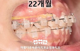 수술후