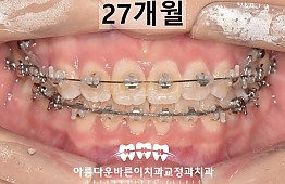 수술후