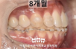 수술후