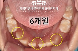 수술후