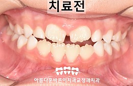 수술전