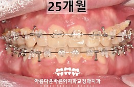 수술후