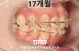 수술후