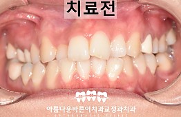 수술전