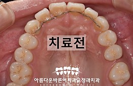 수술전