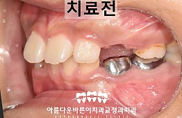 수술전