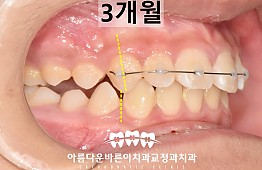 수술후