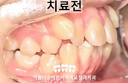 수술전