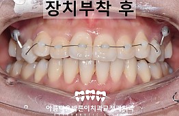 수술후