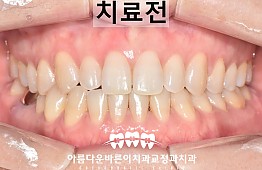 수술전