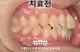 수술전