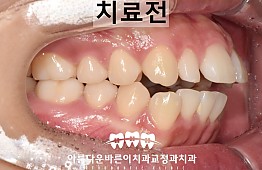 수술전