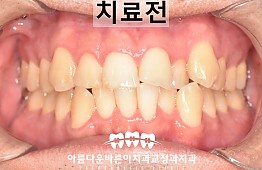 수술전