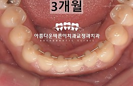 수술후