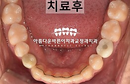 수술후