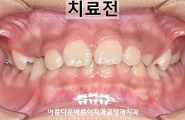 수술전