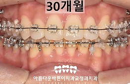 수술후