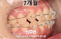 수술후