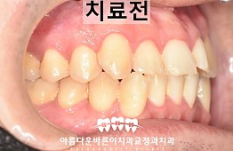 수술전